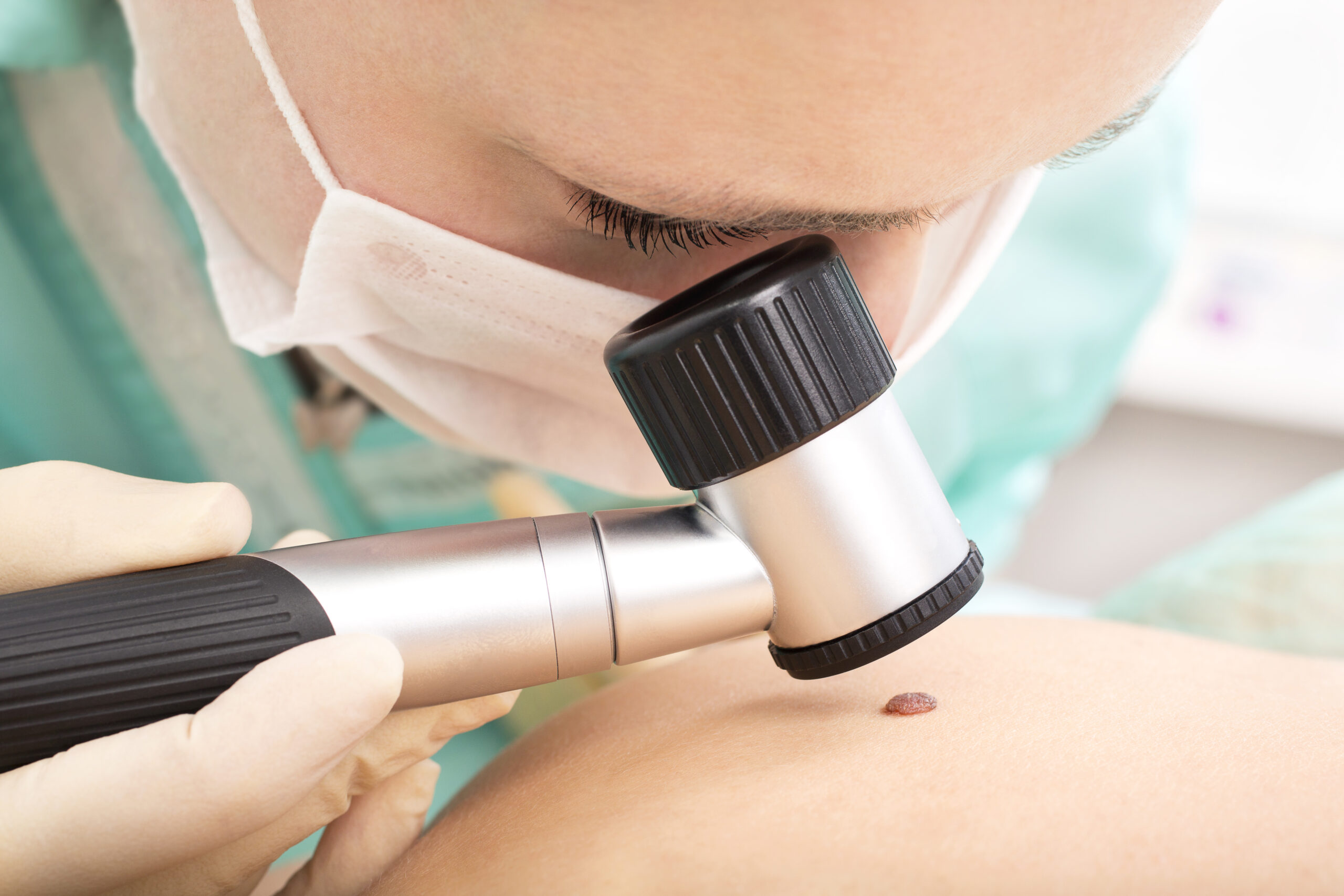 Medico examinando com uma lupa uma verruga