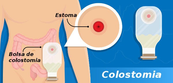 Desenho ilustrando o corpo humano e uma bolsa de colostomia